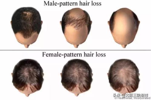 怎么分辨脱发的类型,脱发原因有几种类型