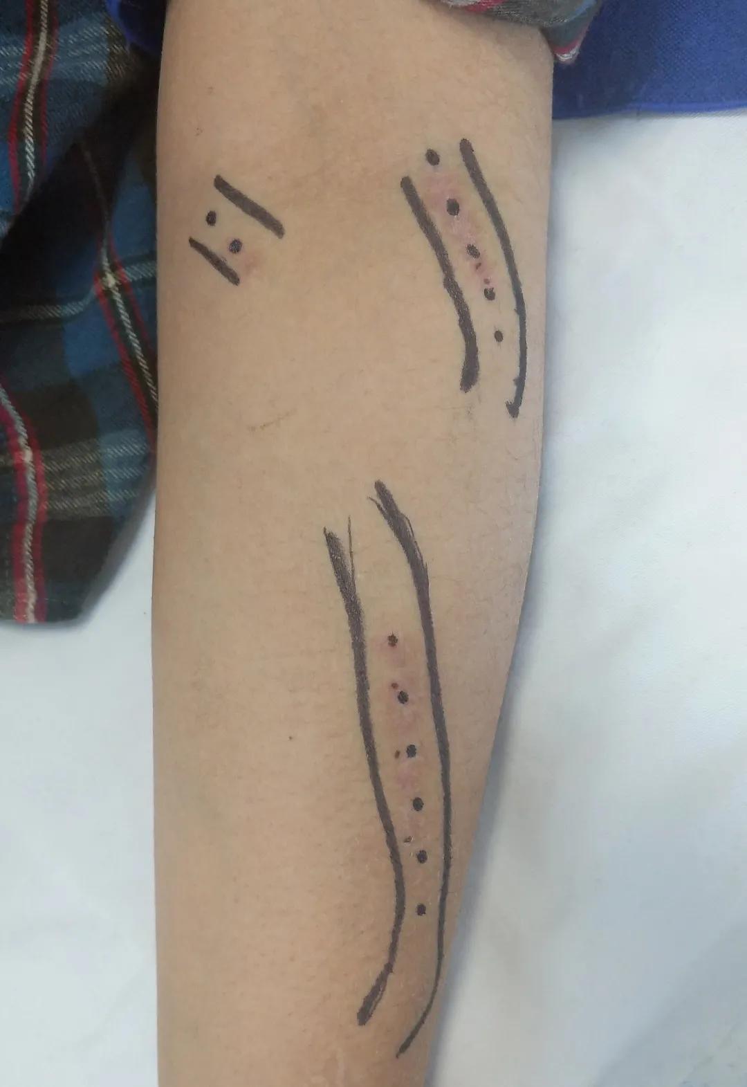 动静脉内瘘的日常护理宣教视频,血透病人动静脉内瘘的护理