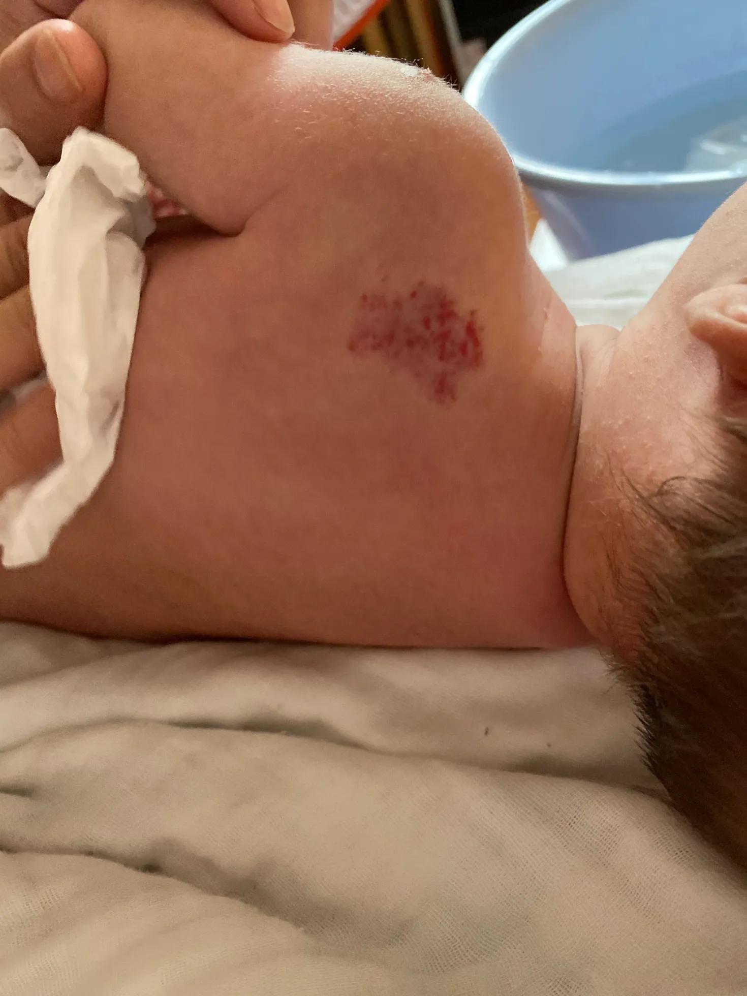 宝宝血管瘤用眼药水以后1个月淡化好多（带图）