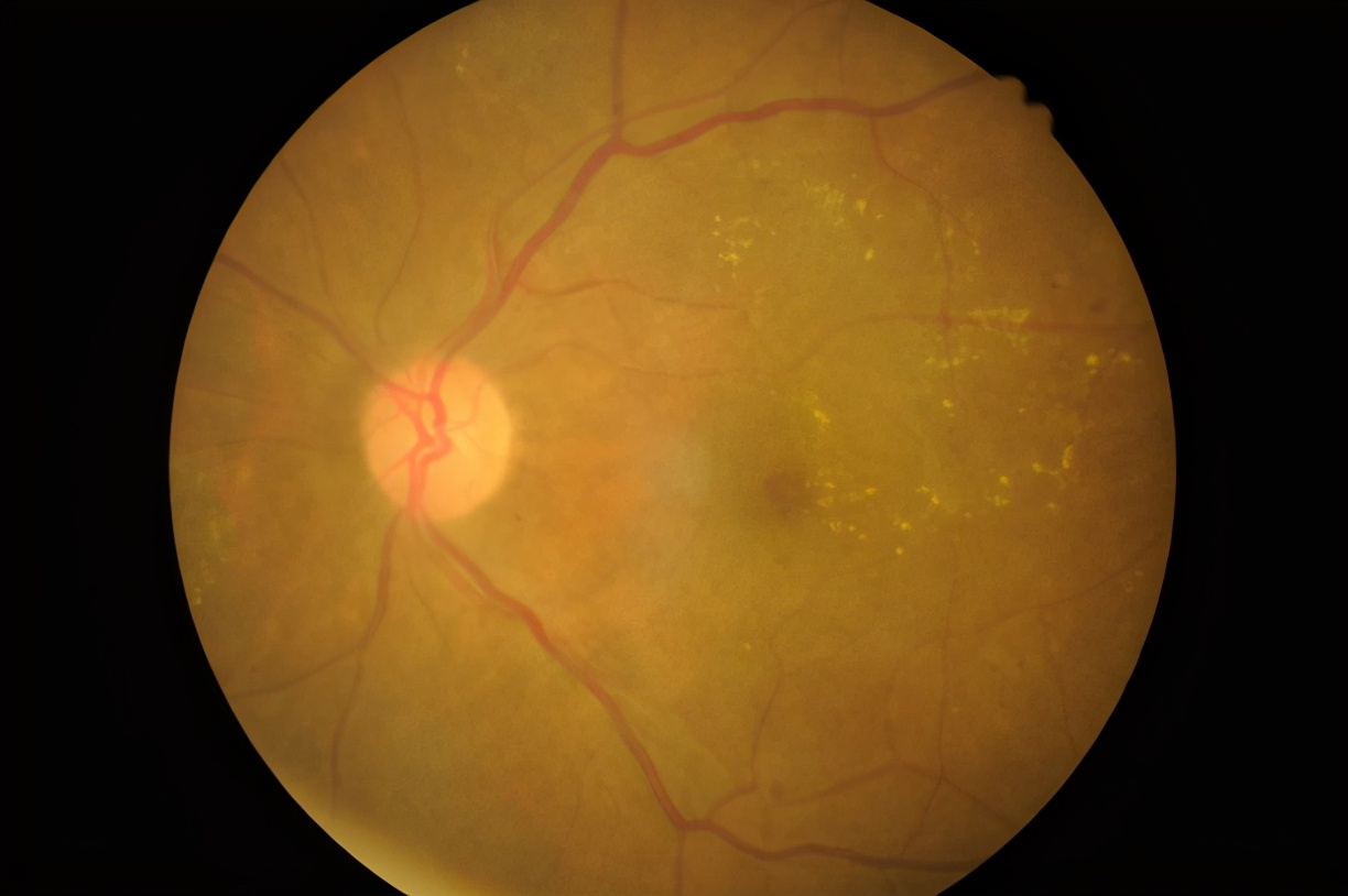 视网膜色素变性夜盲后几年失明,视网膜色素变性一定有夜盲症吗