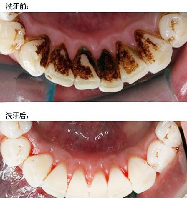 洁牙后，牙齿出现黑斑，是蛀牙了吗？再也不去洁牙了