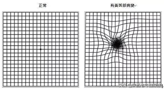 眼睛看不到东西医生说是黄斑病变,最近眼睛里长了黄斑