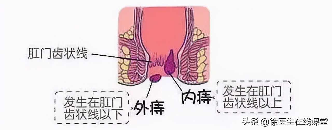 肛门边有个肉球不痛不痒怎么治疗,肛门外有个肉球不痛不痒怎么治疗