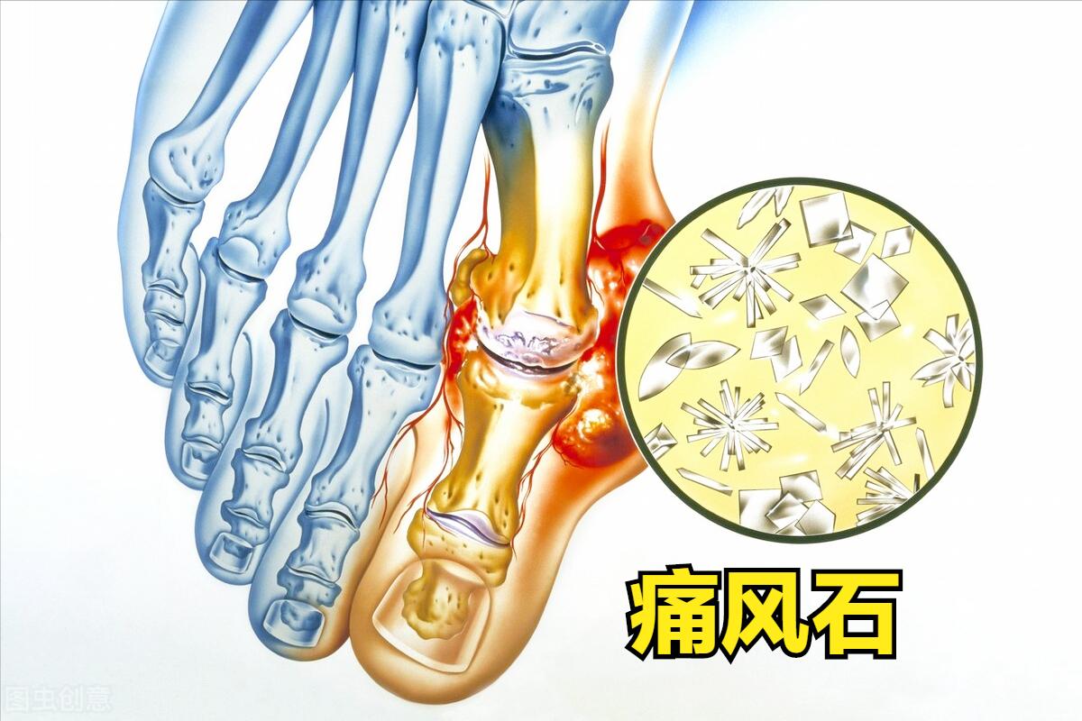 尿酸嘌呤都不高会得痛风吗,尿酸高痛风会引起肾结石吗