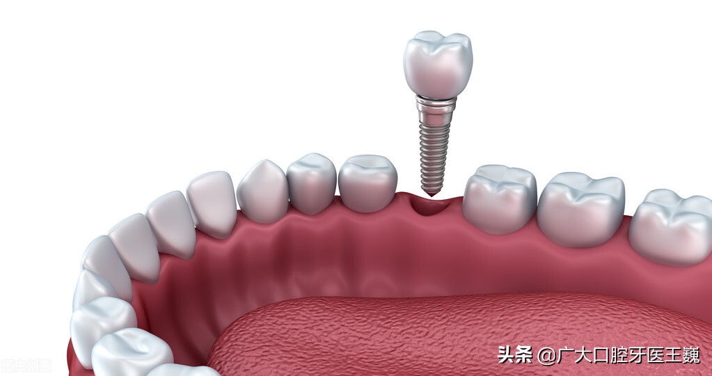 全口活动假牙的真实感受,活动假牙为什么淘汰