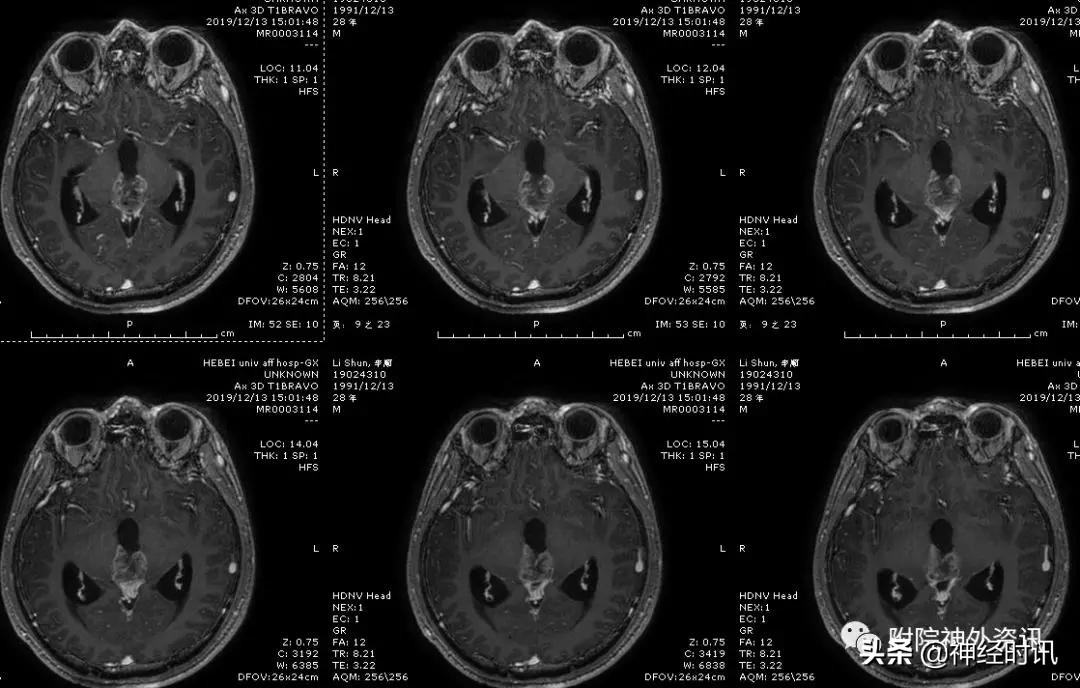 松果体占位怎样治疗,松果体区占位看什么科室