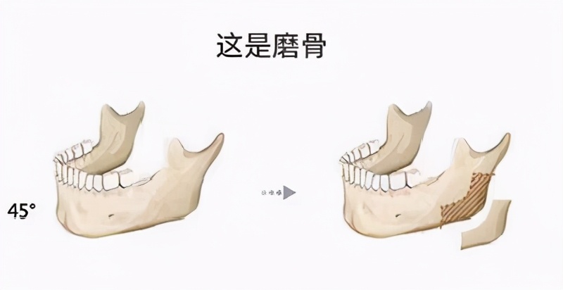 下颌角宽大怎么改善男生,怎样改善下颌变小
