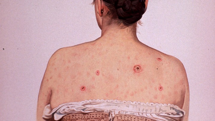 梅毒单发红疹,梅毒手脚上比较典型的疹子