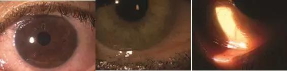 干眼症为什么要查过敏原,怎么判断是过敏还是干眼