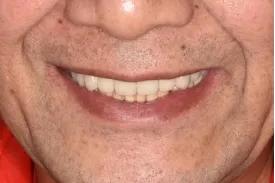 长沙牙齿种植的费用,长沙种植牙视频