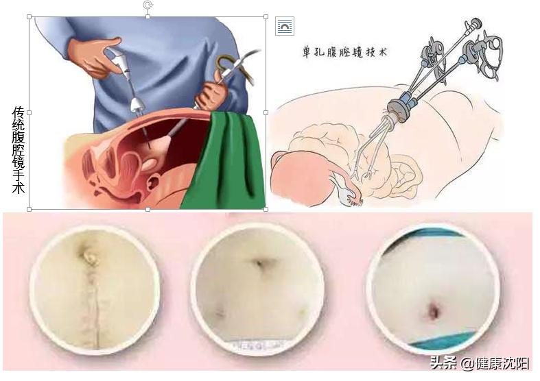 分辨卵巢囊肿好坏,卵巢囊肿的由来