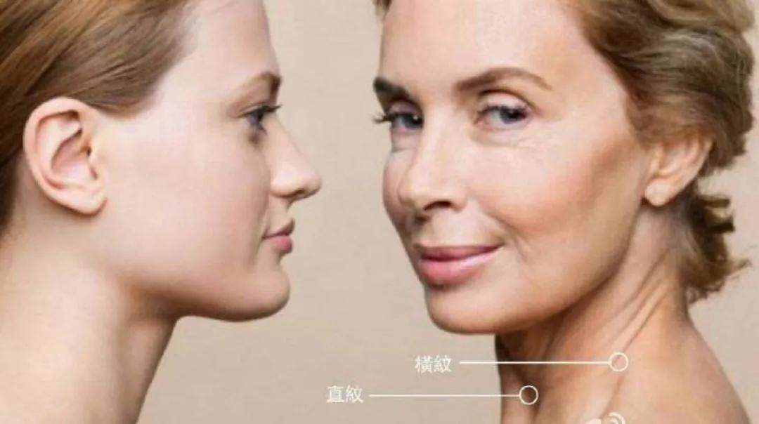 脖子上的颈纹很深能用医美解决吗,去脖子上颈纹最好办法