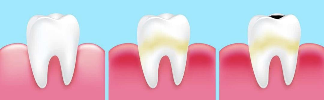 2岁小孩乳牙蛀牙补牙多少钱一颗,8岁小孩乳牙蛀牙补牙一年后发炎