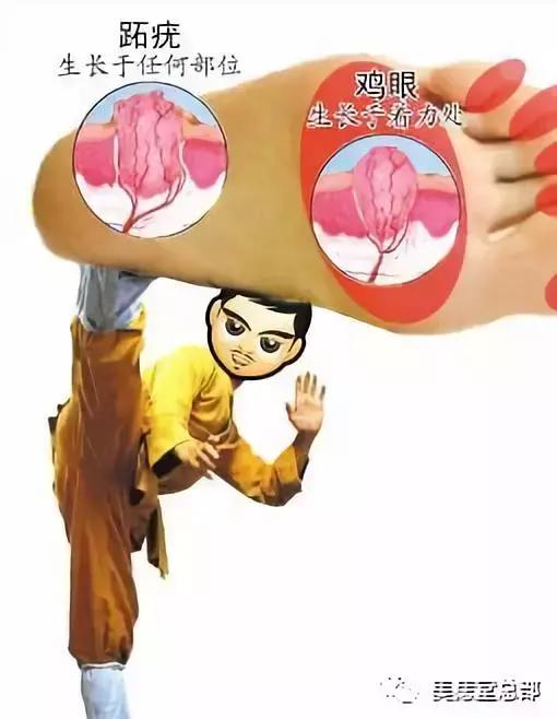 脚底鸡眼和跖疣的区别,挤鸡眼和跖疣的区别
