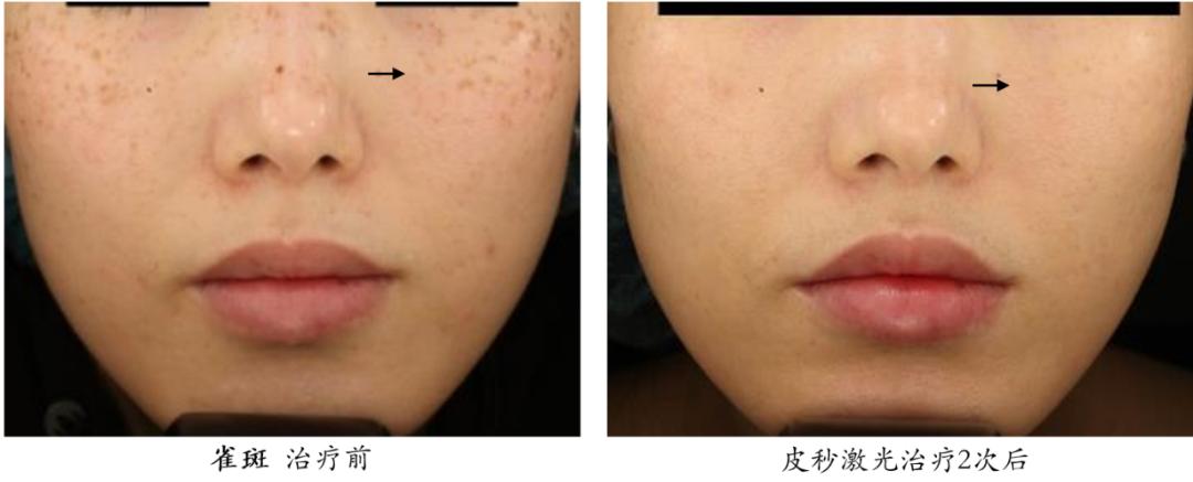 皮秒激光祛斑能保护表皮不受损伤,超皮秒激光祛斑的危害与效果视频