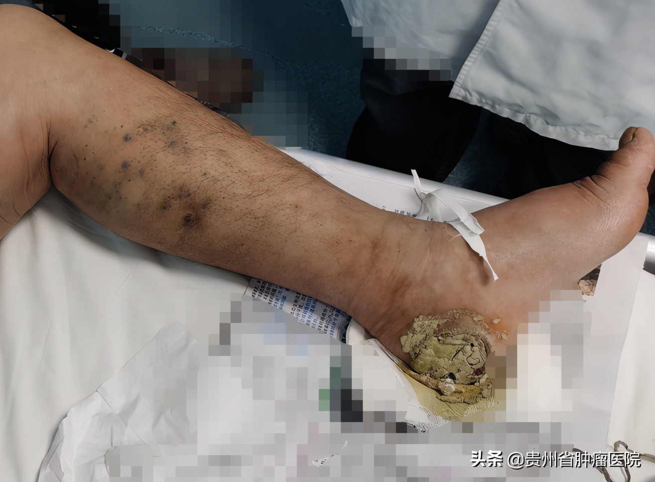 眼睛黑色素瘤的特征,眼睛黑色素瘤的早期症状