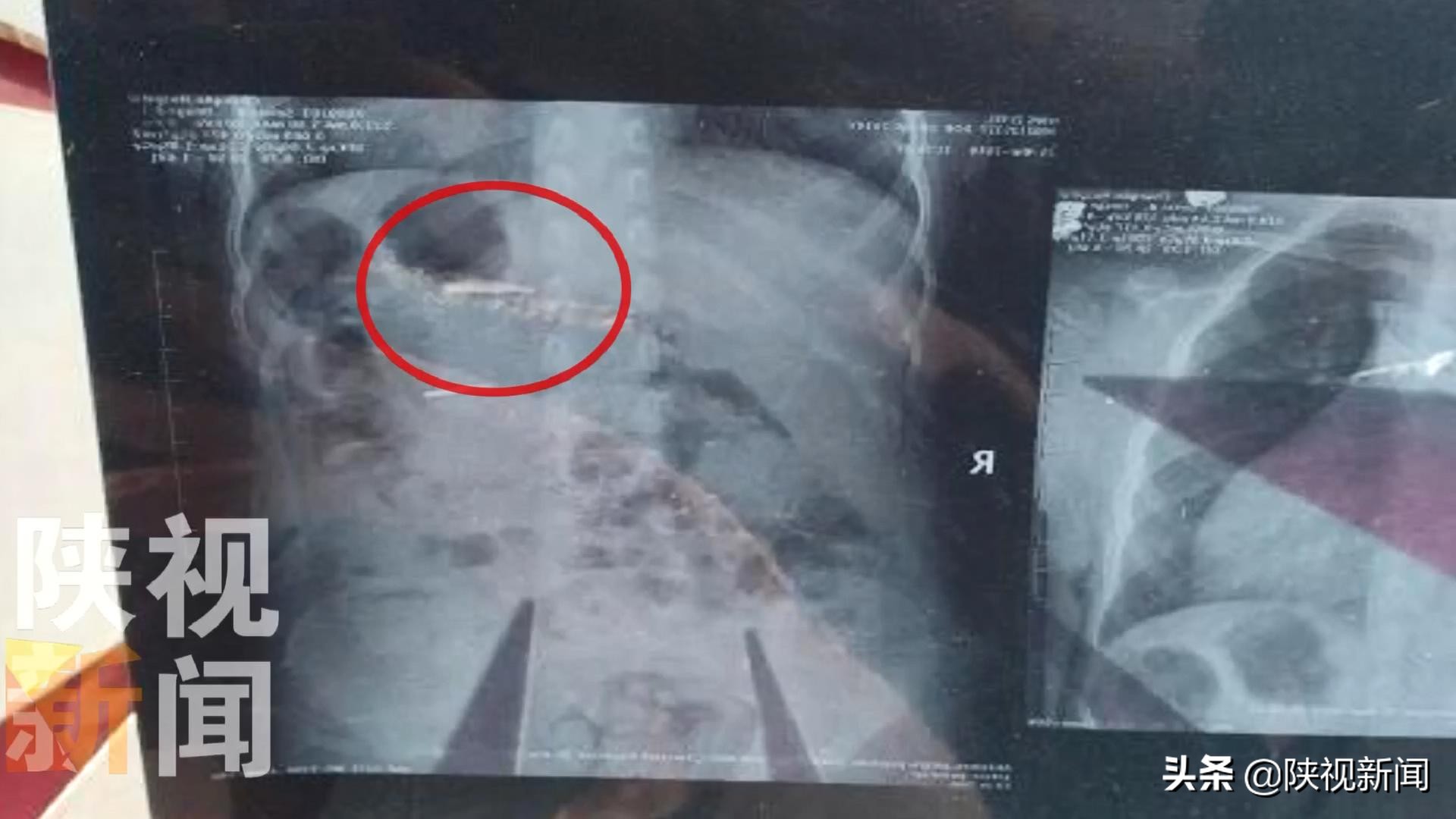 西安4岁女童看牙时打磨针掉入消化道除了双方协商莫让这样的“意外”再发生是关键