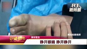 大连一男子聚餐后醉酒冻僵截肢了,男子醉酒躺路边冻僵