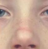 过敏性鼻炎眼袋发黑怎么去掉,过敏性鼻炎导致的眼袋怎么去除