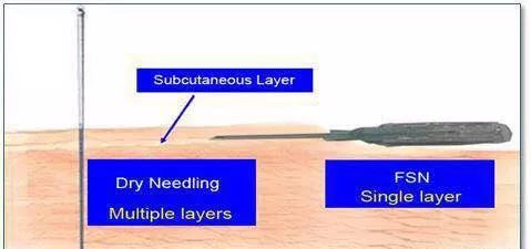 网球肘的预防保健注意事项有哪些,受凉引起的网球肘最快治愈方法