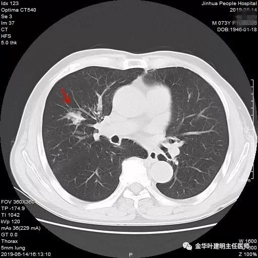 能不能手术,极重度混合性通气功能障碍能治吗