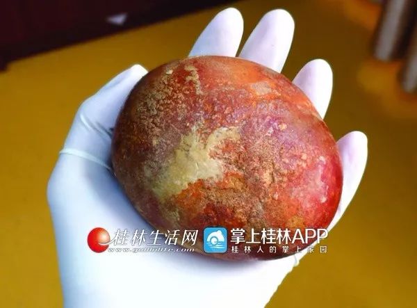 9岁体内取出巨大结石,大爷体内取出15厘米结石上海