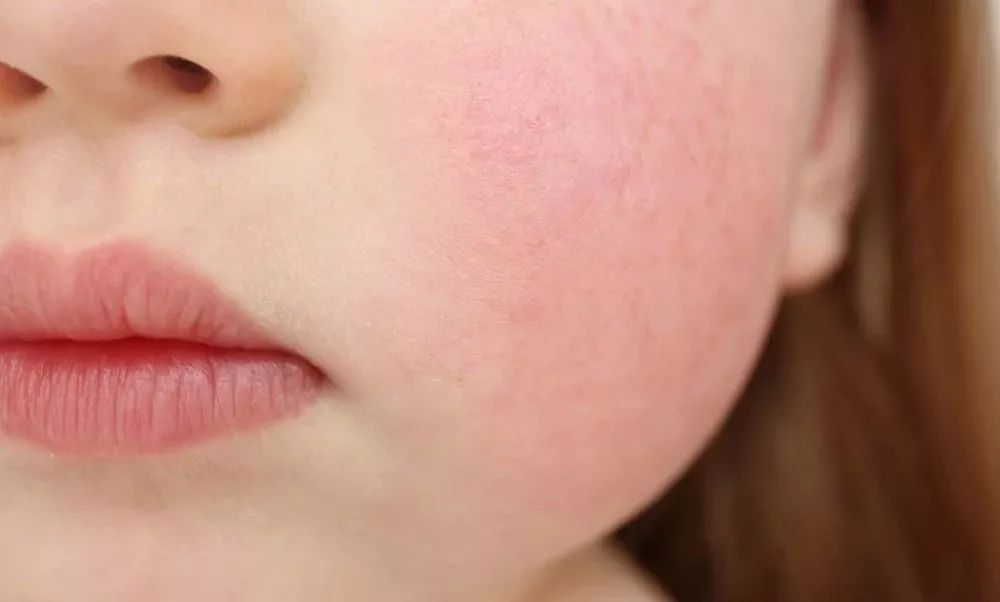 小孩子嗓子发炎用什么抗生素,孩子感冒嗓子有痰用吃抗生素吗