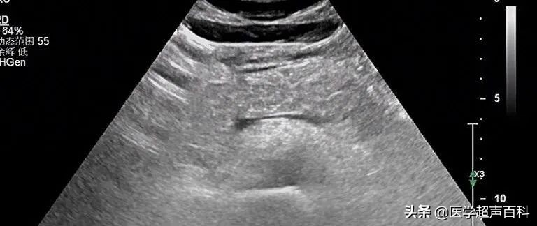 消化系统急性胰腺炎病人的护理,急性胰腺炎胃肠功能恢复的标志