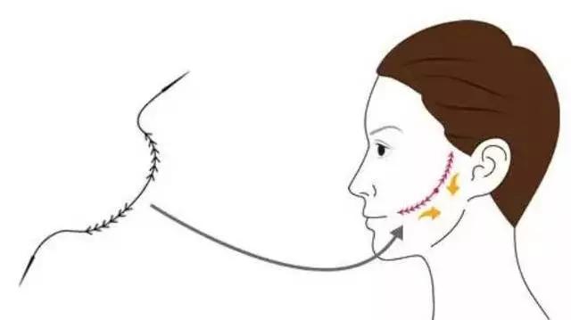 张宗学博士线雕案例分析,张宗学线雕案例