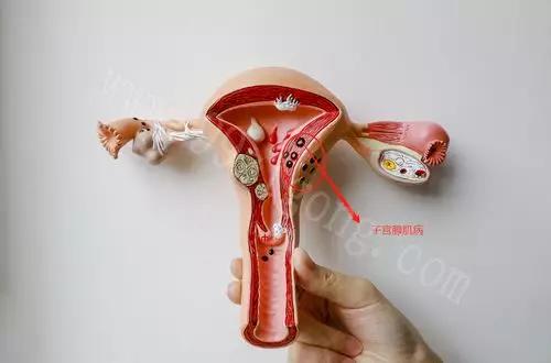 子宫腺肌病是种什么病,治疗子宫腺肌病的药物