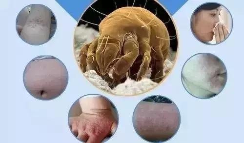 床上有螨虫放什么东西能除螨,床上螨虫和细菌最怕什么