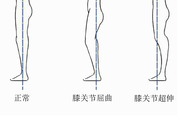 超膝伸肌肉腿怎么矫正,膝超伸和o型腿怎么改善