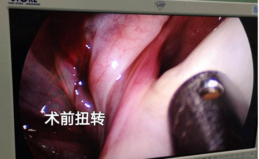 怀孕初期卵巢囊肿扭转怎么办,怀孕了查出来卵巢囊肿需要手术吗