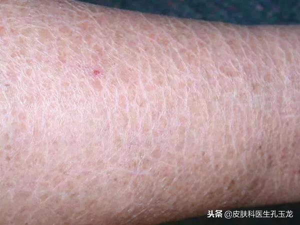 小腿上一小块皮肤病怎么区分,小腿长了一小块类似皮癣的东西