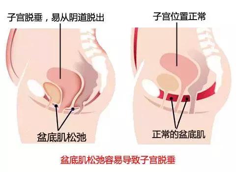 产康妈咪丨生完娃就万事大吉了吗？产后千万不要忽视这项检查
