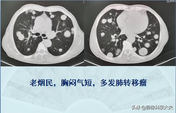 癌症晚期肺转移还能活多久,肺癌症晚期能有必要化疗吗