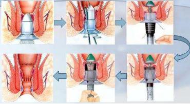 痔疮的奇闻怪事,肛肠科的奇闻异事