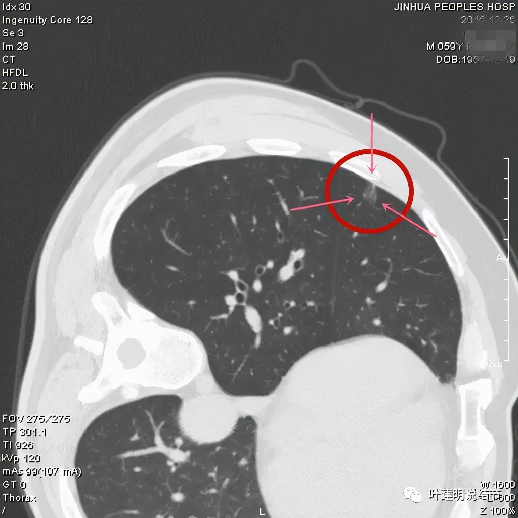 从活检怎么看是非小细胞癌,从病例谈辨证论治