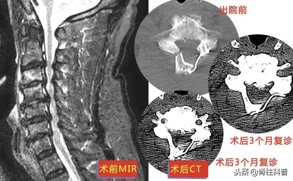脊髓型颈椎病急刹车,严重颈椎病早期的10大症状