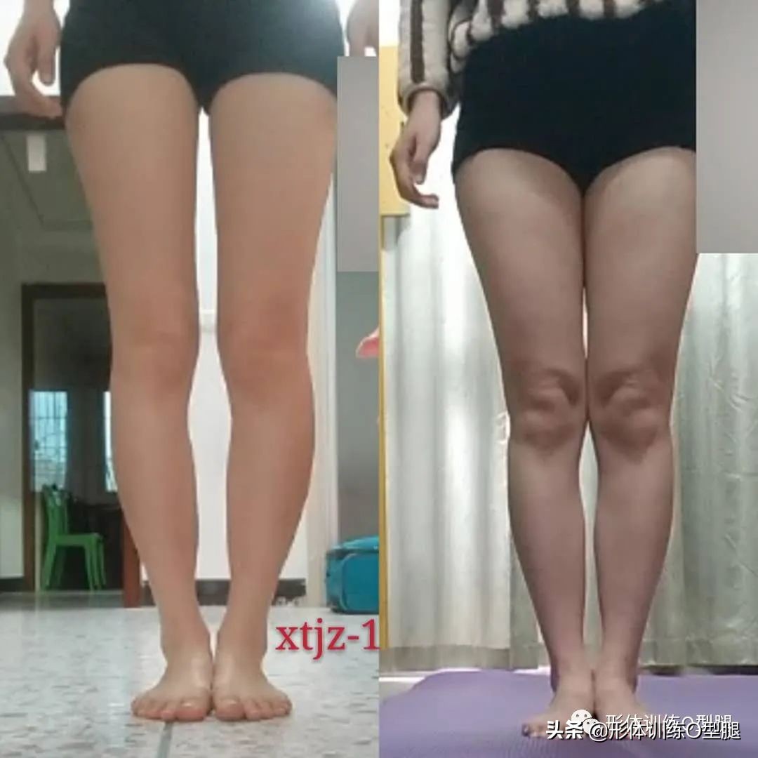 怎样矫正o型腿罗圈腿,o型腿的原因和矫正