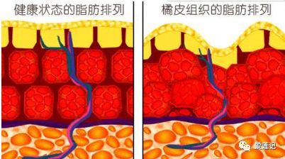 肥胖纹和皮疹的区别,肥胖纹和橘皮纹的区别
