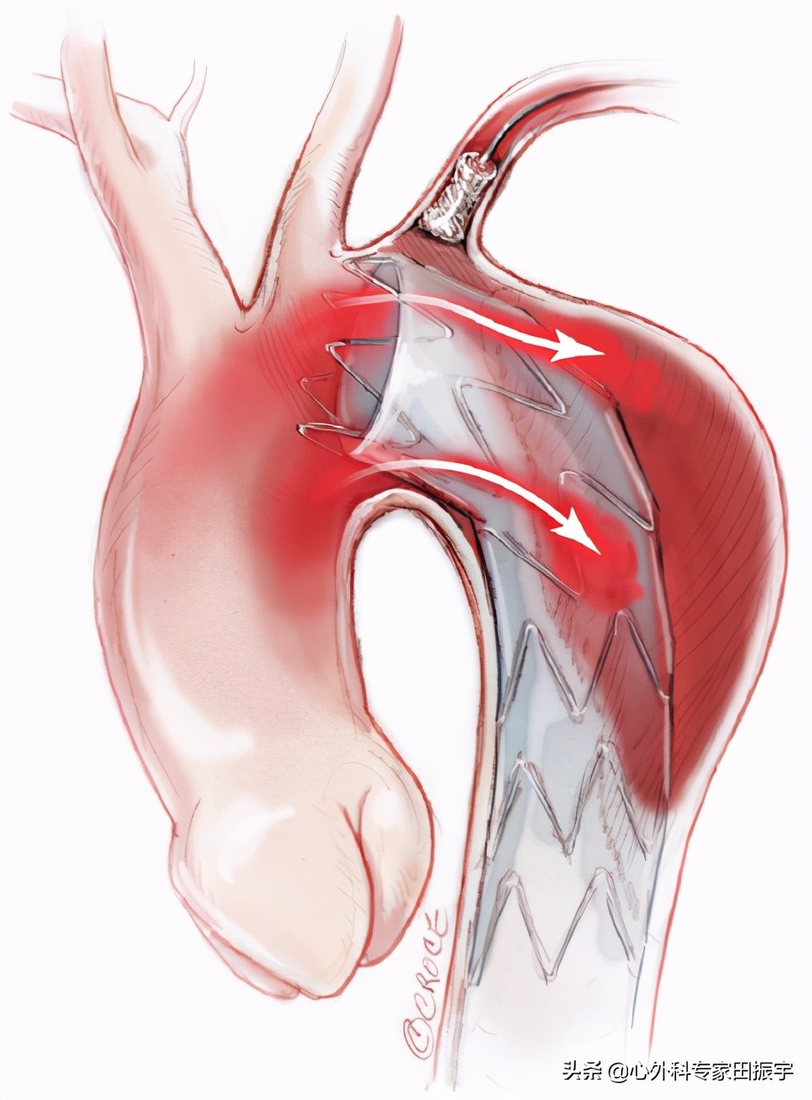 主动脉夹层破裂b型,急性主动脉夹层动脉瘤破裂