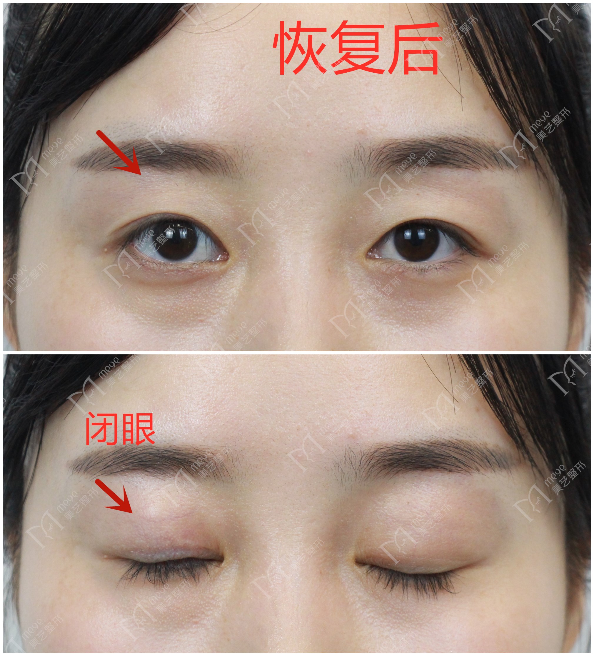 做双眼皮时判断出肌无力但未提肌,做双眼皮说是眼睛肌力不够