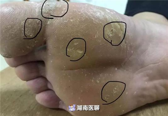 跖疣和鸡眼拔除全过程,切记不要把跖疣当作鸡眼处理