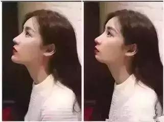 丰下巴可以改善下巴后缩么,丰下巴手术前后对比照片