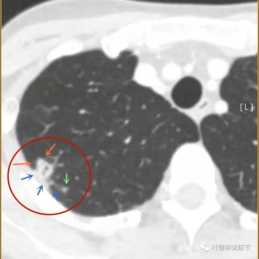 临床诊断孤立性肺结节,空洞型结节一般是什么性质
