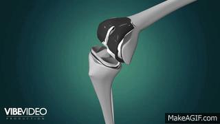 医院发现有骨刺怎么办,膝盖骨刺的正确处理方法视频