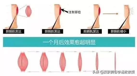 大腿粗小腿细怎么拯救,大腿小腿粗怎么减才有效