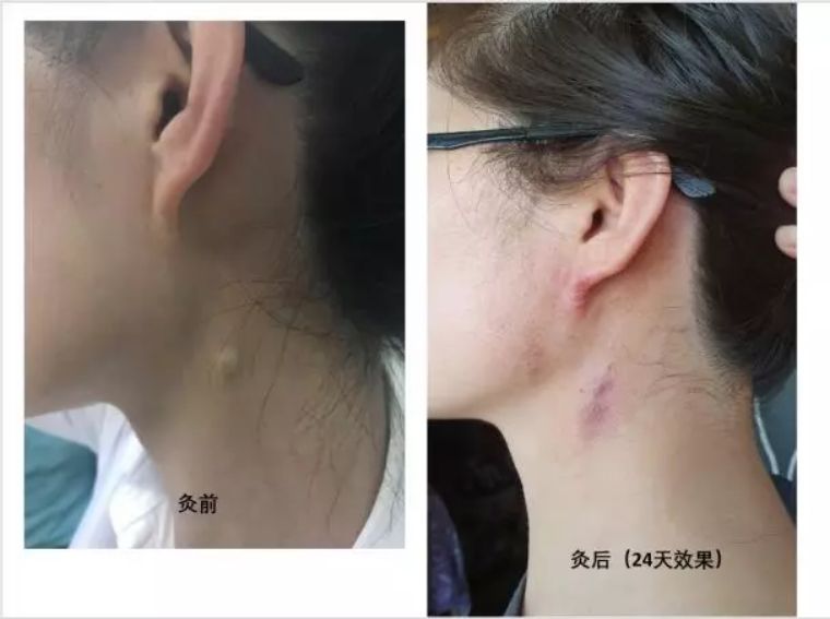 艾灸后出现的这些“不良反应”，居然会让身体更健康