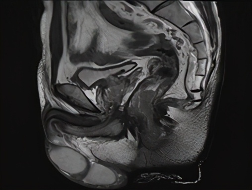 低位直肠癌保肛手术不造瘘利弊,低位直肠癌保肛会影响复发率么